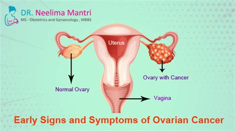 Women are more likely to experience symptoms once the disease has spread beyond the ovaries, typically to the lymph nodes outside the abdomen, the skin, the liver. What are the Early Signs and Symptoms of Ovarian Cancer ...