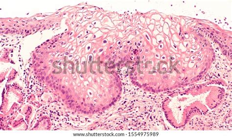 Photomicrograph Microscopic Image Cervix Biopsy Showing Stock Photo