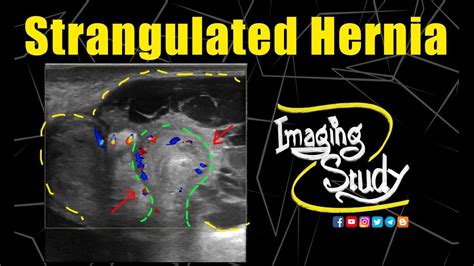 Strangulated Umbilical Hernia Ultrasound