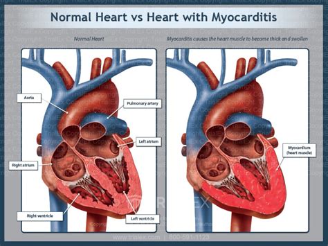 Normal Heart V Heart With Myocarditis Trialexhibits Inc
