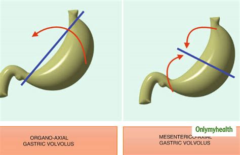 What Is A Volvulus Know The Types Symptoms Causes Diagnosis And