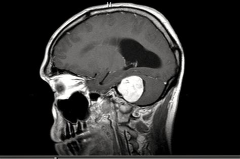 Brain Tumor Diagnosed With An Acoustic Neuroma Part 1 Hubpages