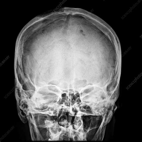 Eosinophilic Granuloma Of Skull Stock Image C0430304 Science