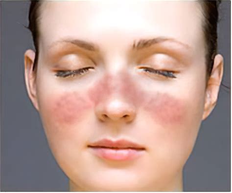 Lupus Facial Rash Telegraph