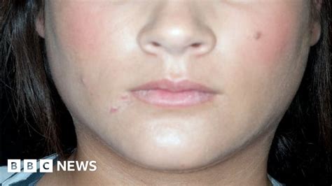 Mumps Is It The Forgotten Disease Bbc News