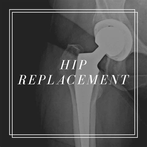 Frequently Asked Questions About Hip Replacements