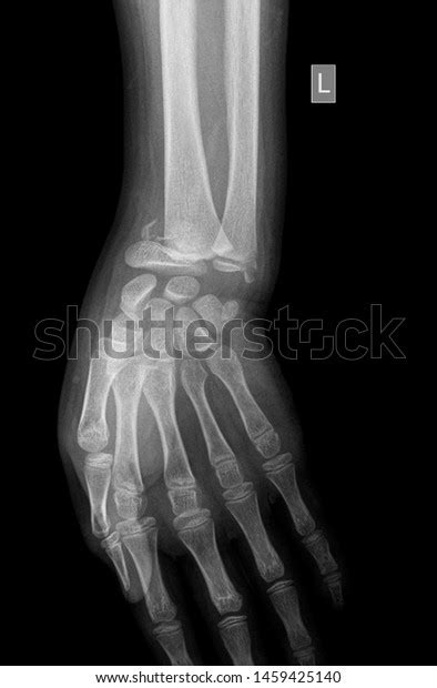 Wrist X Ray Anatomy Radiology Radiographic Stock Photo 1459425140