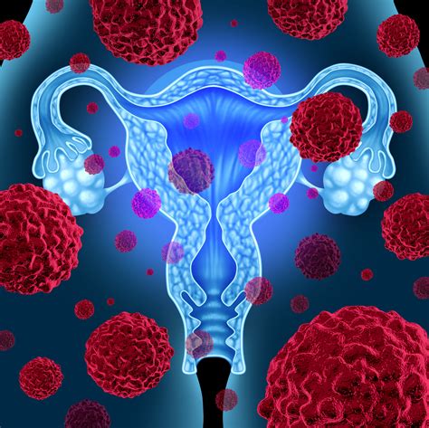 Further Advancements In Ovarian Cancer Gives Shows Promising Results