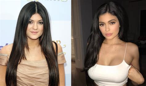 Kylie Jenners Plastic Surgery Transformation The Blemish