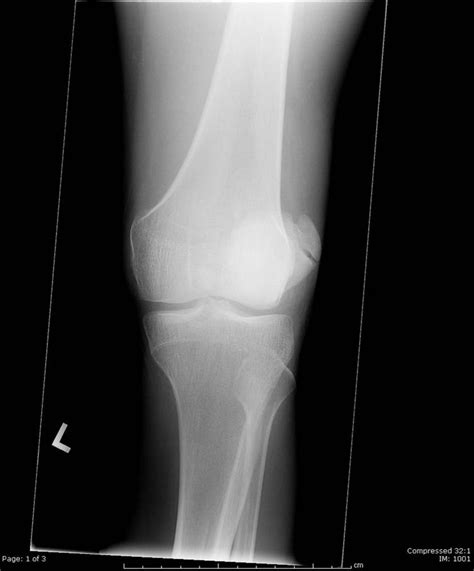 Patellar Instability Knee And Sports Orthobullets