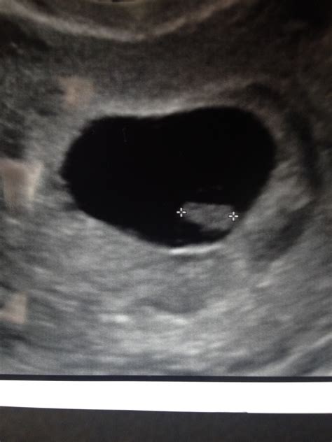 8 Week Ultrasound Showing Only Fetal Pole No Baby No Heartbeat No