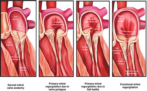 Frontiers Percutaneous Mitral Valve Interventions Repair Current