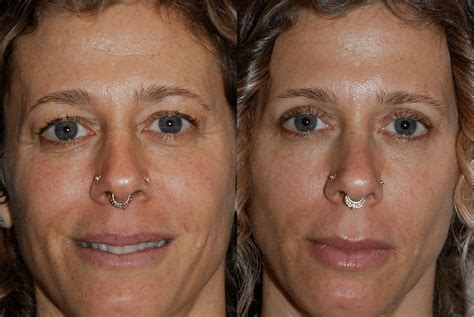 Eyelid Surgery Before And After Artemedica