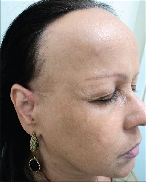 Top 73 Hairstyles For Frontal Fibrosing Alopecia Ineteachers
