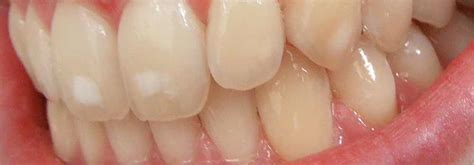 White Spots On Teeth Why Are They There And How Do You Get Rid Of Them