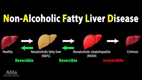 The Growing Epidemic Of Fatty Liver Disease Causes Effects And How