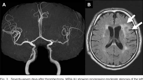 Figure From A Case Of Delayed Symptomatic Middle Cerebral Artery Stenosis Following Mechanical