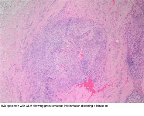 Pathology Outlines Idiopathic Granulomatous Mastitis