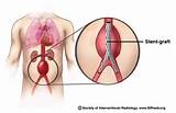 Aortic Aneurysm Stent Recovery Time Images