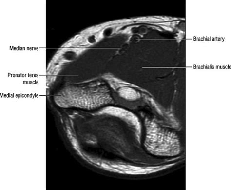 Entrapment Neuropathies Of The Upper Extremity Teachme Orthopedics