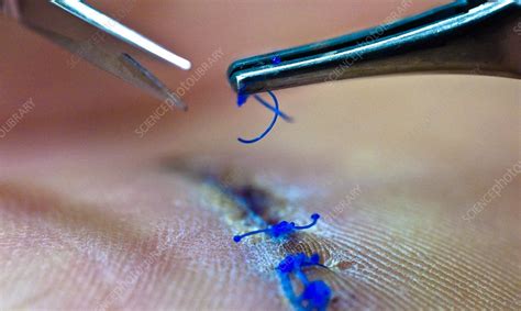 Surgical Sutures Stock Image C0119821 Science Photo Library