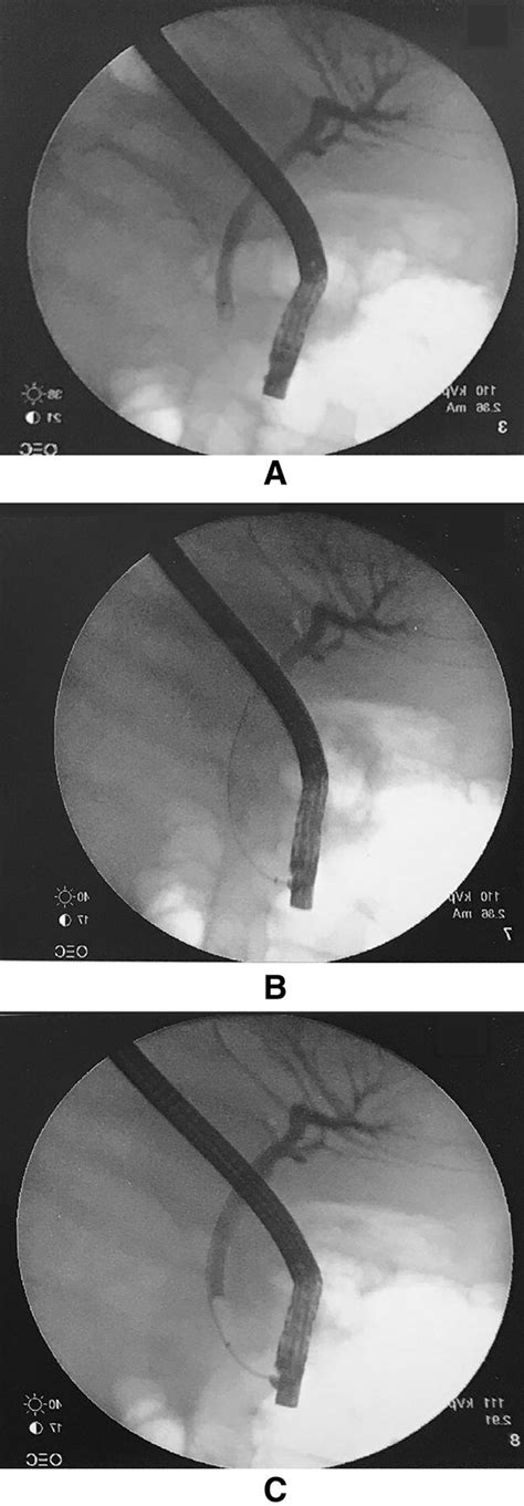 Ercp Cholangiogram Ac Different Phases Of Contrast Dye Injection In
