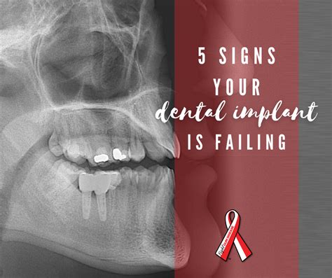 5 Signs Dental Implant Is Failing Fight Gum Disease