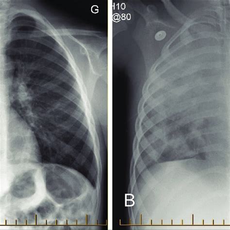 Chest Radiographs A Hospital Day 1 At The Referring Community