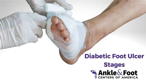 Diabetic Foot Ulcer Treatment And Prevention What To Know