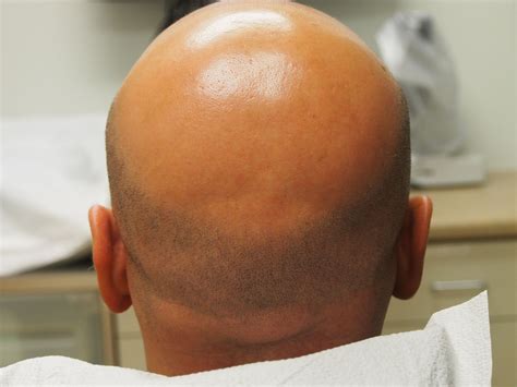Pin On Male Pattern Baldness