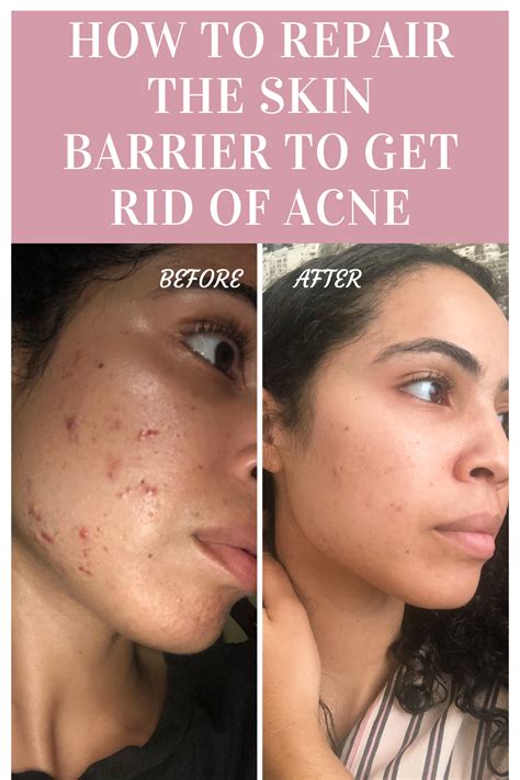 Repairing The Skin Barrier To Get Rid Of Acne Before And After Results How To Get Rid Of Acne