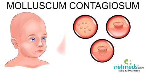 Molluscum Contagiosum Causes Symptoms Transmissions R