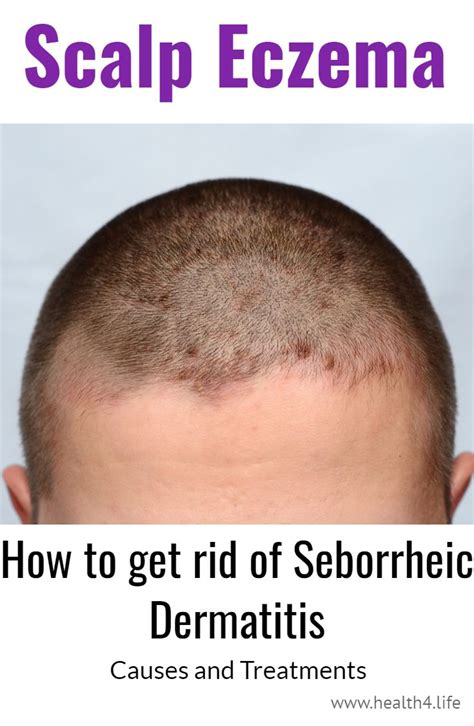 How To Treat Dermatitis On Scalp A Comprehensive Guide The 2023 Guide
