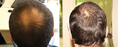 Hair Transplant Before After Images Receding Hairline Thinning Hair