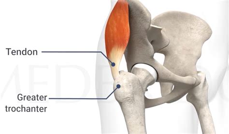 Gluteal Tendinopathy And Age Trends Fpt