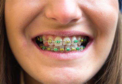 Braces Colors That Look Good Together