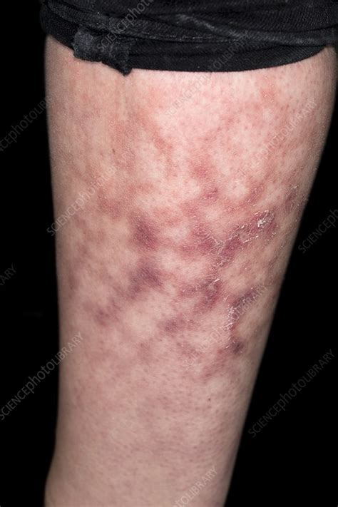 Reticulated Erythema Stock Image C0295247 Science Photo Library