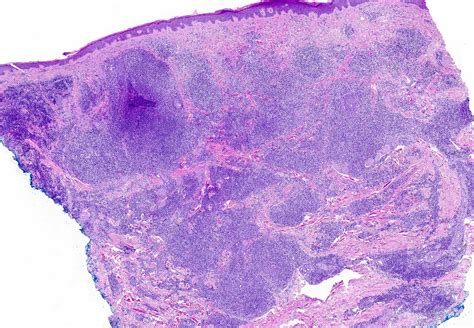 Pathology Outlines Cutaneous Lymphoid Hyperplasia
