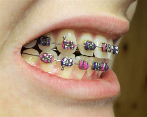 Brackets De Colores Las Mejores Combinaciones Y Tendencias