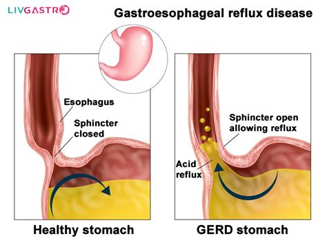 Gastroesophageal Reflux Disease Causes Risk Factors Symptoms