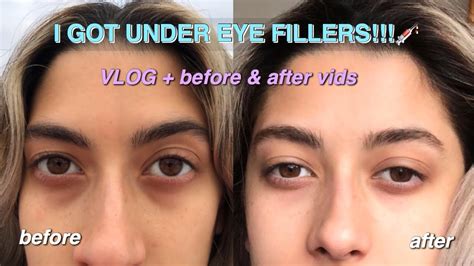I Got Under Eye Filler For My Dark Circles Vlog Before And After