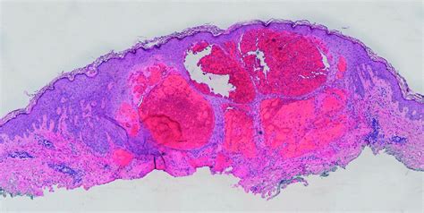 Angiokeratoma Histopathological Examination Multiple Ectatic Download Scientific Diagram