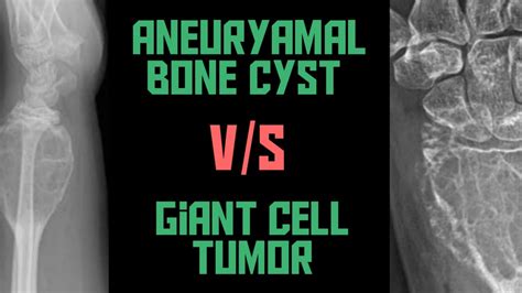 Giant Cell Tumor VS Aneurysmal Bone Cyst GCT VS ABC Xrays