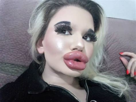 Woman With Biggest Lips In World Has 26 Injections To Look Like Bratz