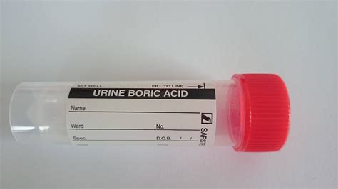C Peptide Creatinine Ratio Ucpcr Urine Blood Sciences Test
