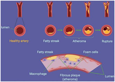 Is Atherosclerosis A Disease Of Modern Times · Frontiers For Young Minds