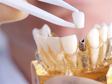 Dental Implant Prosthetic Options Dentistry Today