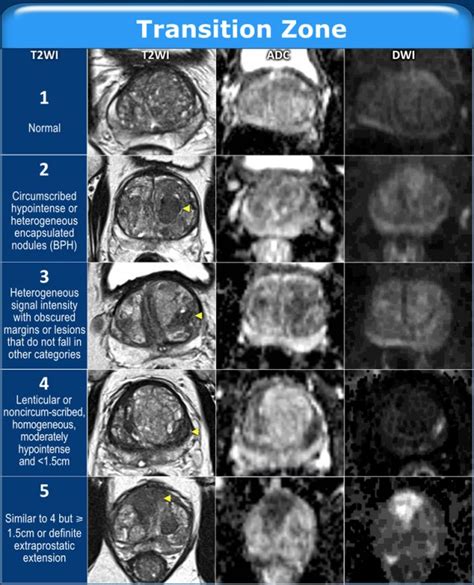 Prostate Gland Anatomy Mri