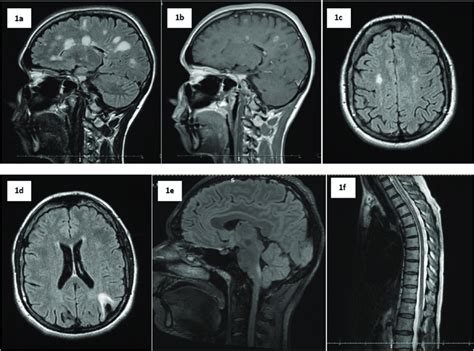 Different Types Of White Matter Lesions In Cns Inflammatory Diseases