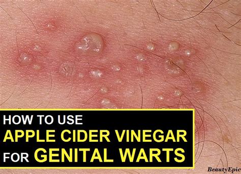 Apple Cider Vinegar For Genital Warts How To Use It